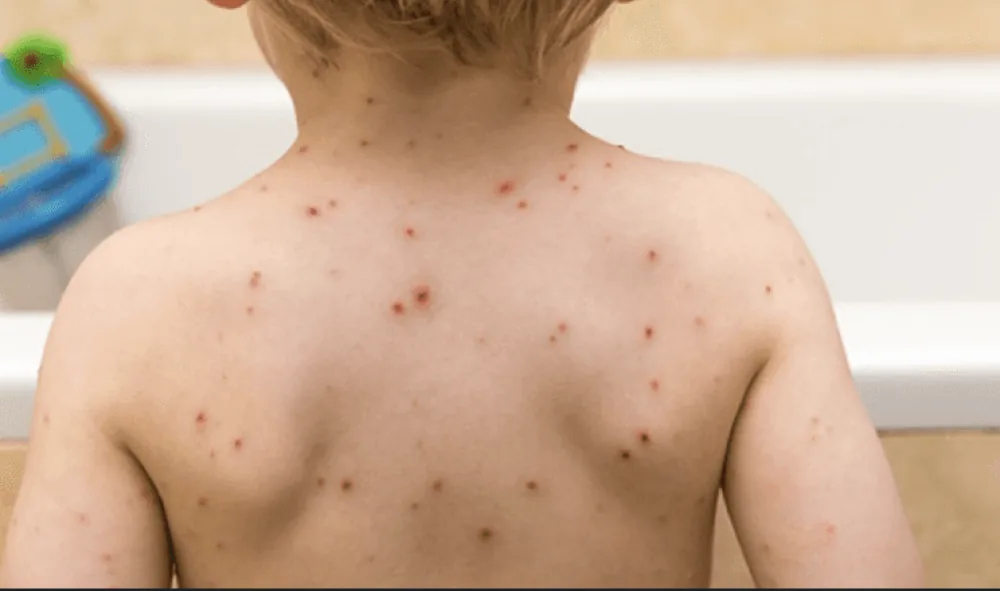 Chickenpox vaccination