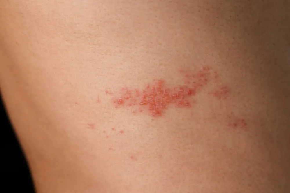 Shingles treatment