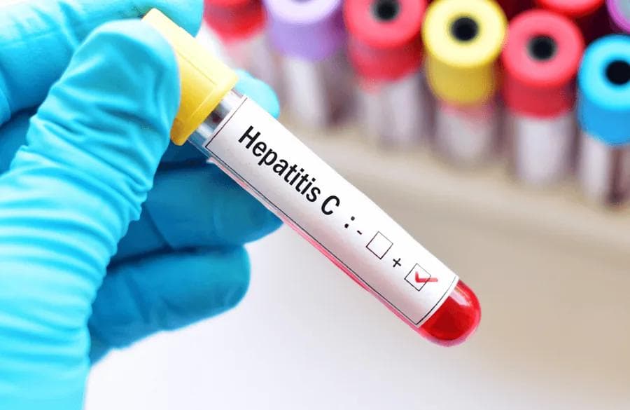 HIV & Hepatitis C Test