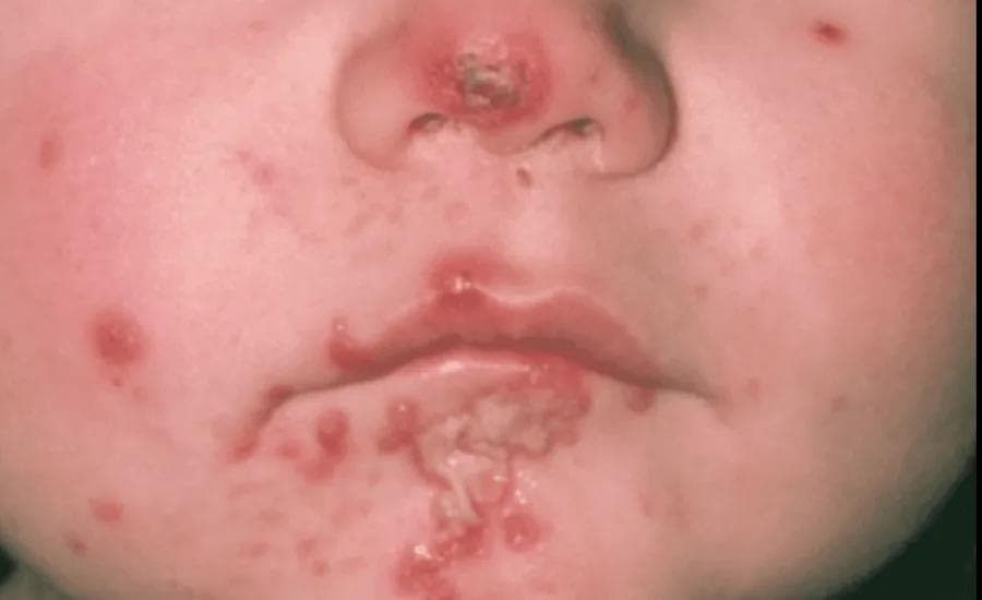 Impetigo Treatment