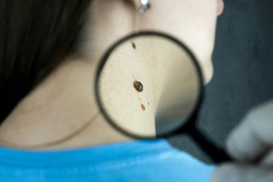 Mole Scanning